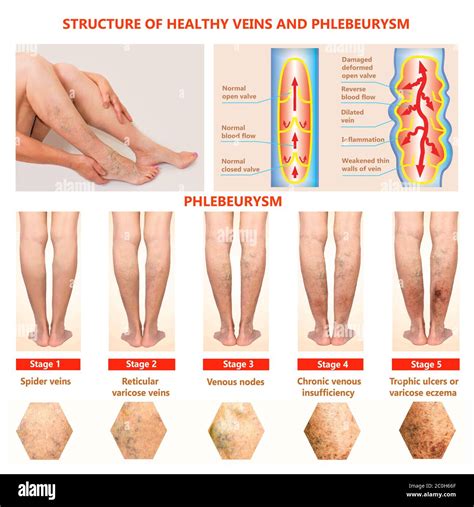 Thrombophlebitis Leg