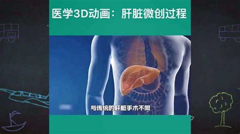 医学3d动画演示：肝脏微创过程，保护好你的小心肝，戒酒 健康养生 健康常识 好看视频