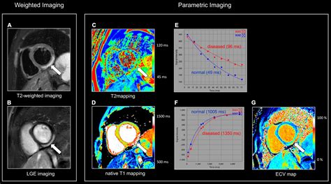 Frontiers Role Of Cardiovascular Magnetic Resonance To Assess Cardiovascular Inflammation