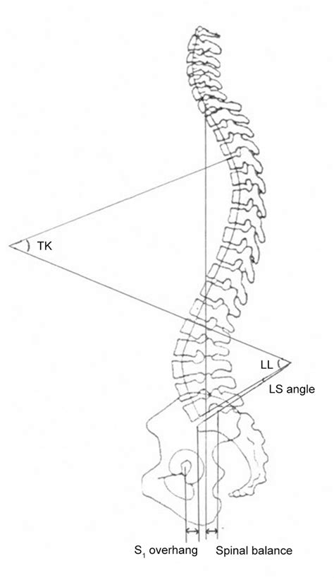 Lumbar Lordosis Angle