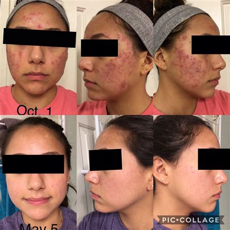 Banda 2 Months Post My 7 Month Accutane Journey For All Of Yall Who Think Theres No Hope For