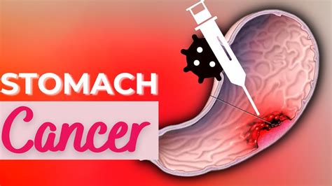 Stomach Cancer Causes Signs And Symptoms Diagnosis And Treatment