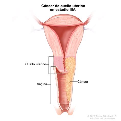 Estadios del cáncer de cuello uterino