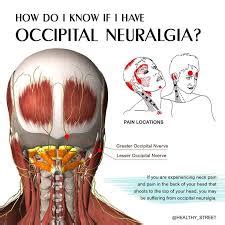 Occipital Neuralgia Tratamientos And Diagnostics Headache