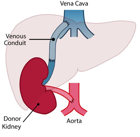 Diagram showing the site of the renal vein and renal artery anastomosis ...