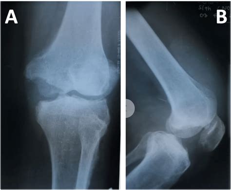 Preoperative Left Knee Radiograph Antero Posterior And Lateral View