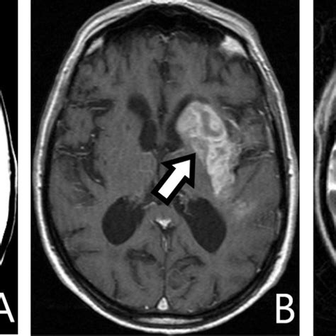 Pdf Mri Of Wallerian Degeneration In The Brainstem A Pictorial Essay