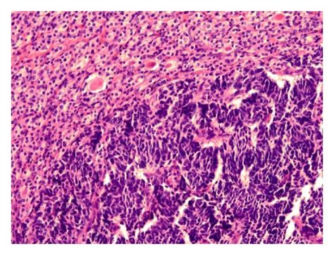 A Within The Encapsulated Follicular Adenoma Is An Abrupt Transition