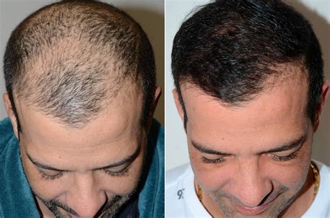 Hair Transplants For Men Photos Miami Fl Patient58764