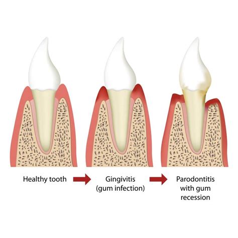 How To Reverse Receding Gums Naturally Reverse Receding Gums Natural