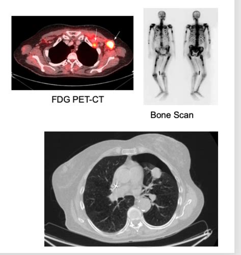 Cancer Diagnosis Flashcards Quizlet