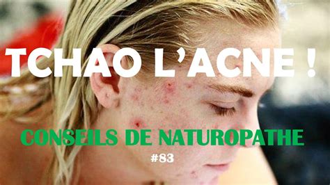 Tchao l Acné Conseil de naturopathe 83 YouTube