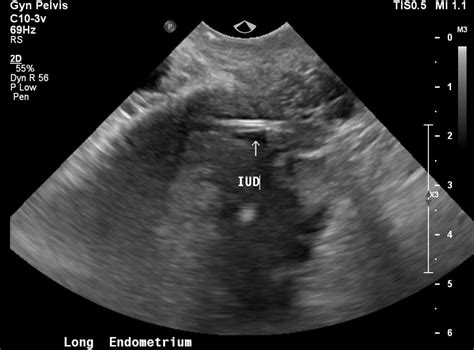 Intrauterine Device Iud Malposition Meded Cases