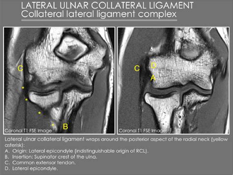 Ulnar Collateral Ligament Elbow Mri