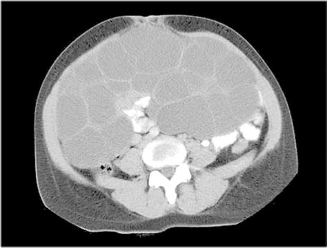 Axial View Of The Abdominal Computed Tomography In The Venous Phase