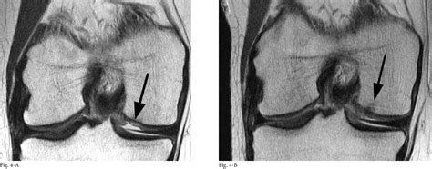 Figure 4 From The Microfracture Technique For The Treatment Of