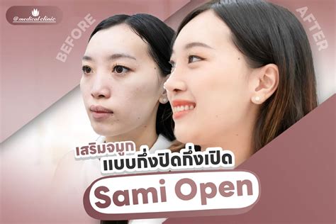 Semi Open ศัลยกรรมเสริมจมูก บริการ