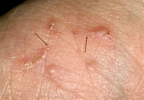 Do Scabies Live On Hard Surfaces At Henry Lackey Blog