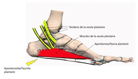 Aponévrosite plantaire Union Cheville Pied