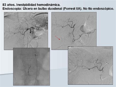 Embolizaci N Arterial De La Hemorragia Digestiva Alta No Variceal