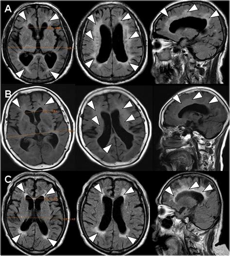 Hydrocephalus Before And After Mri