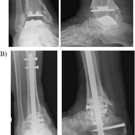 Tibiotalocalcaneal TTC Arthrodesis For Case Of Failed Total Ankle