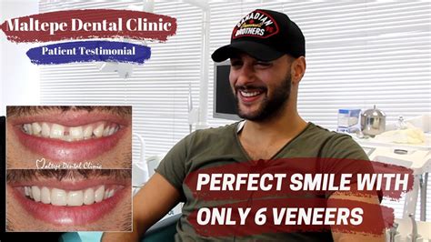 Dental Veneers Behandlung In Der Türkei Die Bewertung 2019 Istanbul