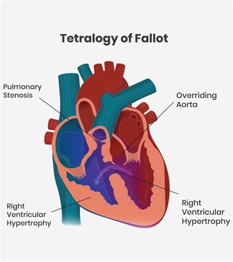 Tetralogy Of Fallot Tof In Babies Symptoms And Treatment