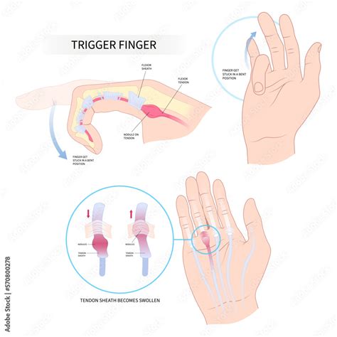 diabetes palm hand cyst flexor pain anatomy medical and Dupuytren's gout index lock tendon wrist ...