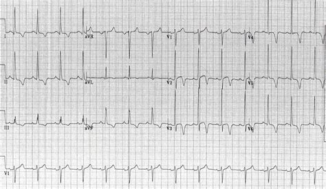 Ecg Rhythms Global T Wave Inversions In A Patient With Cva