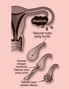 Terapi Untuk Infertilitas Wanita Dan Pemeriksaan Hsg Mom Two Bee