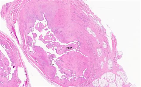 Intravascular Papillary Endothelial Hyperplasia Of The Foot A Rare