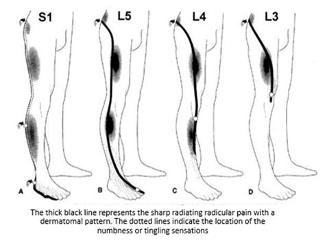 L4 5 Nerve Root Compression