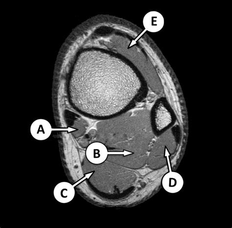 Soleus Muscle Mri