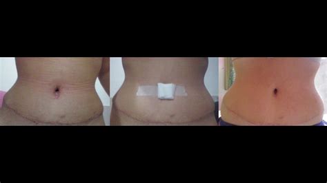 Cirurgia Reparadora Pós Bariátrica Abdominoplastia Update 1 Mês e