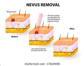 118 Congenital Nevus Images, Stock Photos & Vectors | Shutterstock