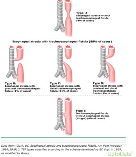 Peds Upper Airway Flashcards Quizlet