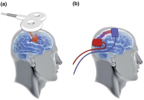 Non Invasive Brain Stimulation Post Stroke Intechopen