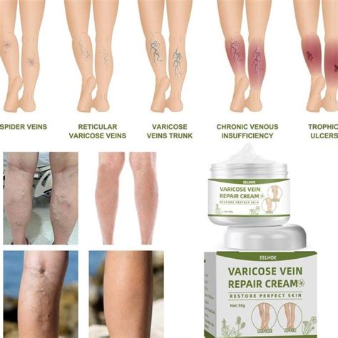 Jual Varicose Veins Treatment Cream Vasculitis Phlebitis Spider