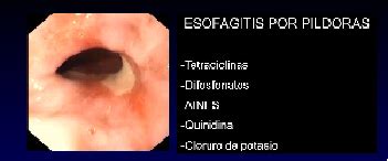 Esofagitis por píldora EcuRed