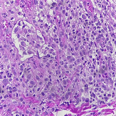 Langerhans Cell Histiocytosis Presented As Persistent Diaper Dermatitis