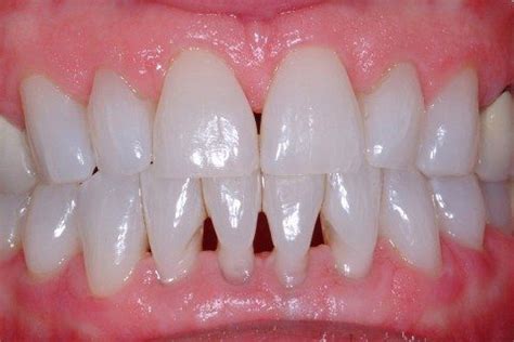 Fixing a Black Triangle - Dr. Noah's Dentistry Blog