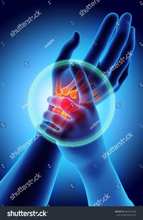 Wrist Painful Skeleton X Ray 3d Illustration Medical Concept