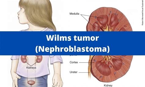 Wilms tumor (Nephroblastoma) | Medical Junction