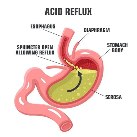 Reflusso Gastroesofageo cos è e quali sono le cause