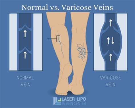 Say Goodbye To Varicose Veins Exploring Modern Vein Treatment Options