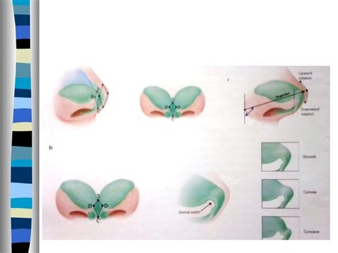 Rhinoplasty Approaches Anatomy Techniques Ppt Free Download