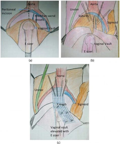 Recurrent Pelvic Organ Prolapse Intechopen