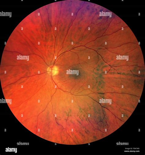 Macula And Fovea