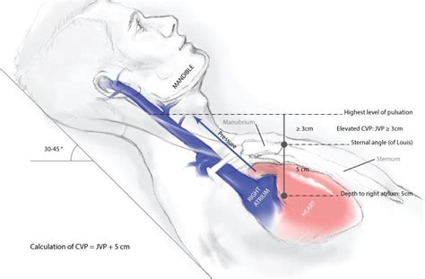 Jugular Venous Pressure Examination and Interpretation : r/usmle